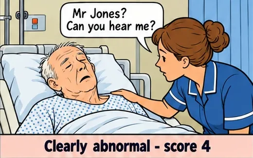 4AT scoring example: a nurse checks alertness in a very drowsy patient. Clearly abnormal, score 4.